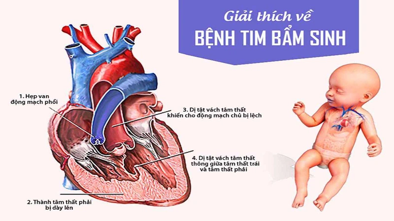 Bệnh tim bẩm sinh ở trẻ em là dạng dị tật của tim