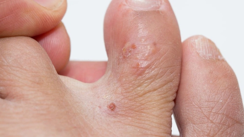 Bệnh tổ đỉa ngón chân: Những điều cần lưu ý 1