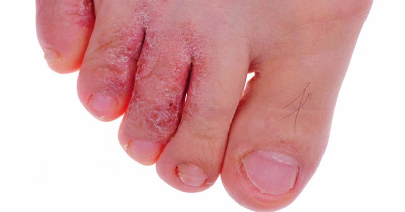 Bệnh tổ đỉa ngón chân: Những điều cần lưu ý 2