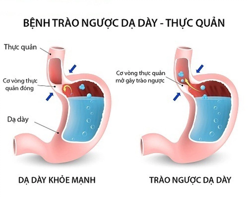 Bệnh trào ngược dạ dày có lây không 1