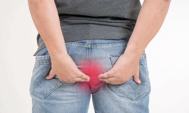 Bệnh trĩ là gì, bệnh trĩ có tái phát không? 1