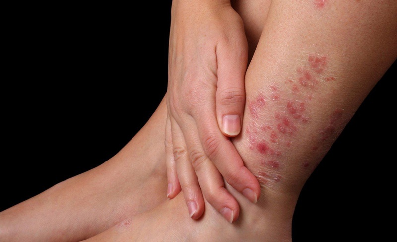 Bệnh vảy nến thể mủ có nguy hiểm không? 1