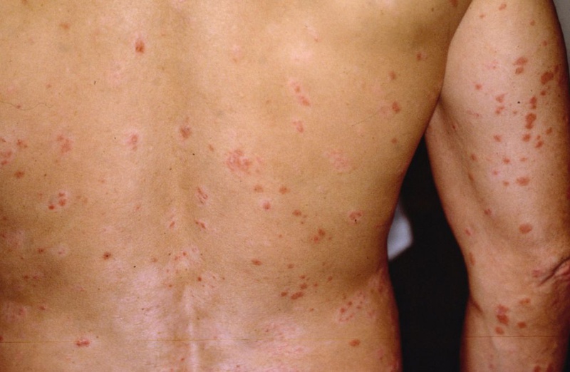 Bệnh vảy nến có ngứa không? 4 mẹo hay khắc phục triệt để