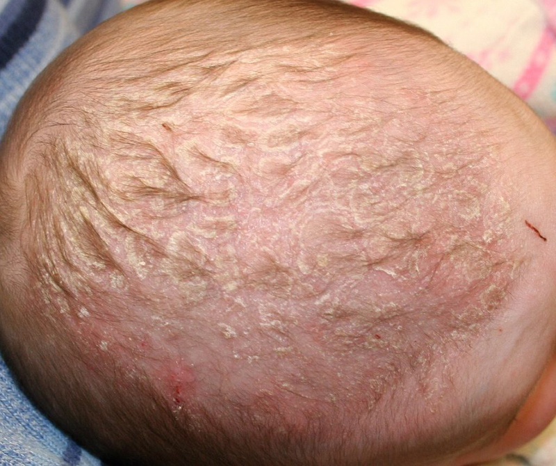 Tìm hiểu những vấn đề xoay quanh bệnh vảy nến ở trẻ em 2