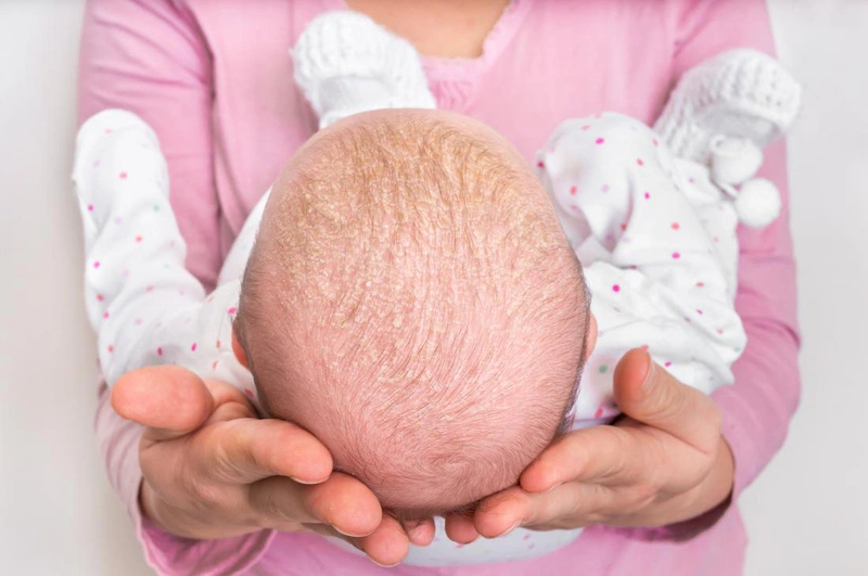 bệnh vẩy nến ở trẻ sơ sinh 1