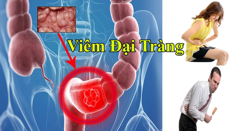 Bệnh viêm đại tràng và các triệu chứng đặc trưng của bệnh 3