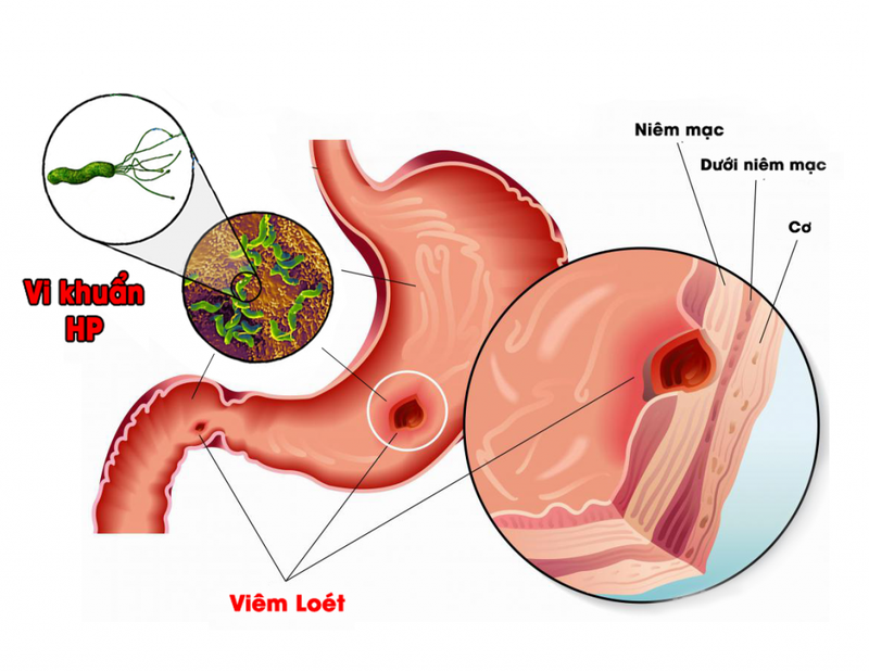 Bênh viêm đại tràng và các triệu chứng đặc trưng của bệnh 4