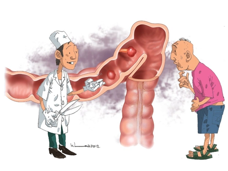 Bệnh viêm đại tràng và trĩ có gì khác nhau 2