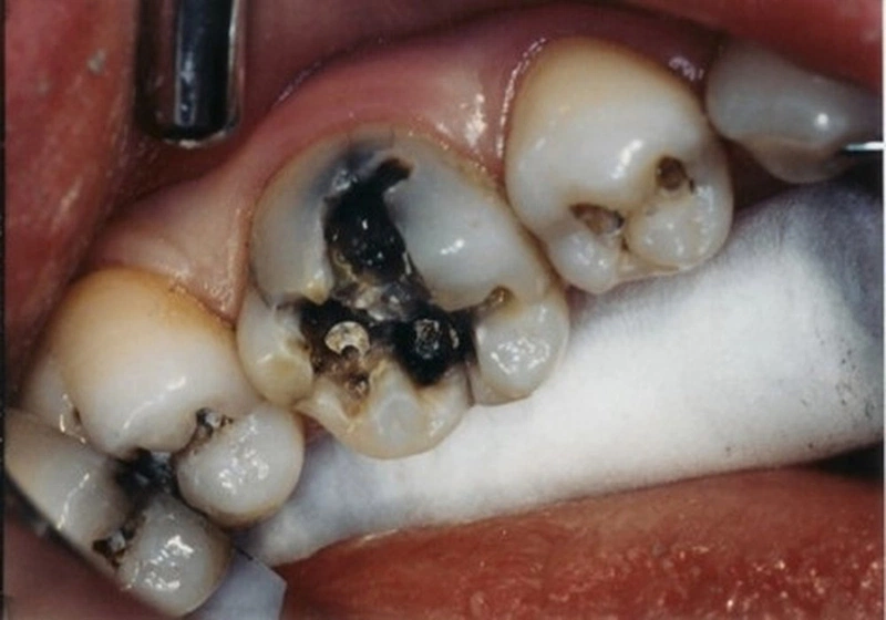 Viêm tủy răng tiến triển có thể dẫn đến nhiều biến chứng nguy hiểm