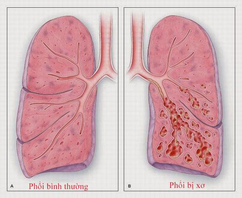Bệnh xơ phổi có lây không? Nguyên nhân gây xơ phổi là gì? 2