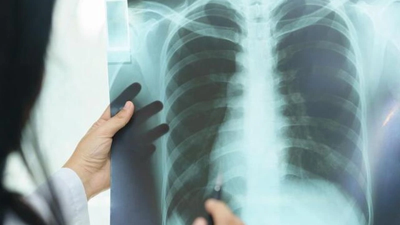 Bệnh xơ phổi sống được bao lâu? Có chữa được không?  1