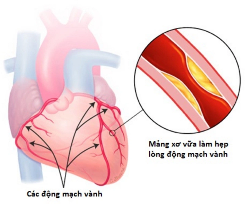 Bị bệnh mạch vành sống được bao lâu? 1