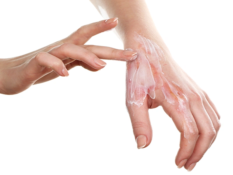 Bị bỏng bôi kem đánh răng có đúng không?