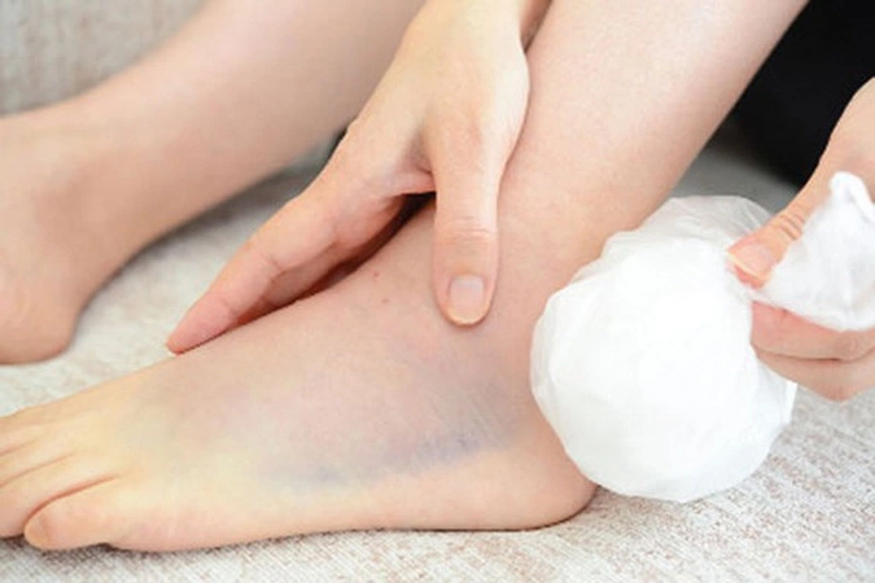 Bị bong gân chườm nóng hay lạnh tốt hơn? 3