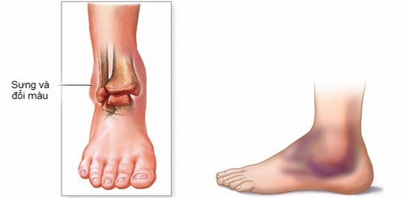 Bong gân khớp cổ chân là hiện tượng các dây chằng xung quanh khớp cổ chân bị giãn quá mức, có thể dẫn đến rách một phần hoặc toàn bộ