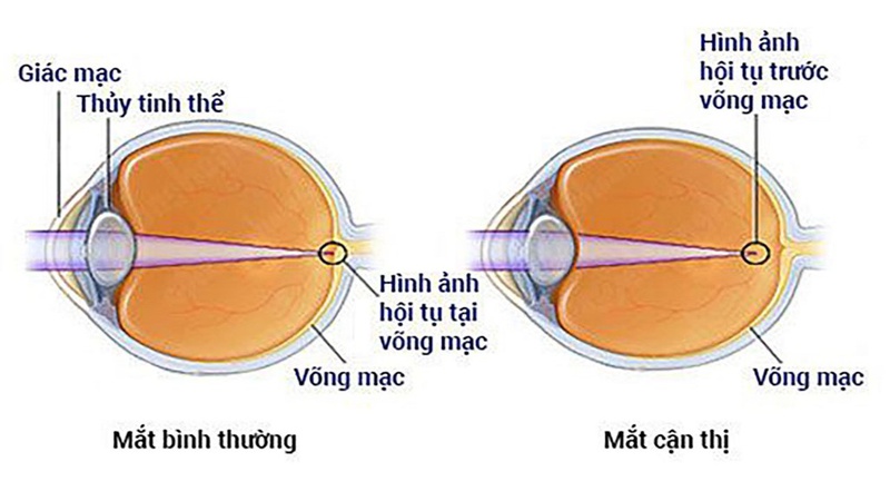 Giải đáp: Bị cận thị có nên uống dầu cá không? - Nhà thuốc FPT ...