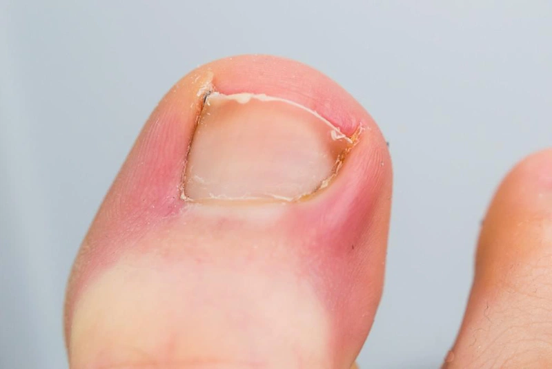 Bị chín mé kiêng ăn gì? 8 thực phẩm gây nguy hiểm bạn cần tránh xa! 1
