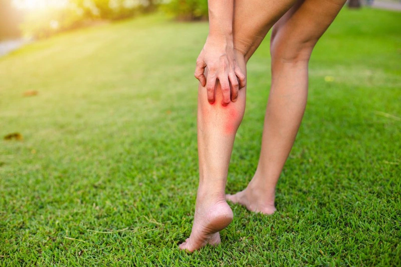 Bị côn trùng cắn sưng phù có nguy hiểm không? Xử lý như thế nào? 1