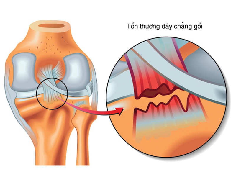 Đứt dây chằng chéo trước đầu gối trở nên lỏng lẻo, chức năng và phạm vi hoạt động bị giảm rõ rệt