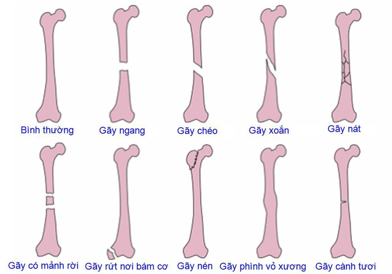 Giải đáp: Bị gãy xương có nên quan hệ hay không? 1