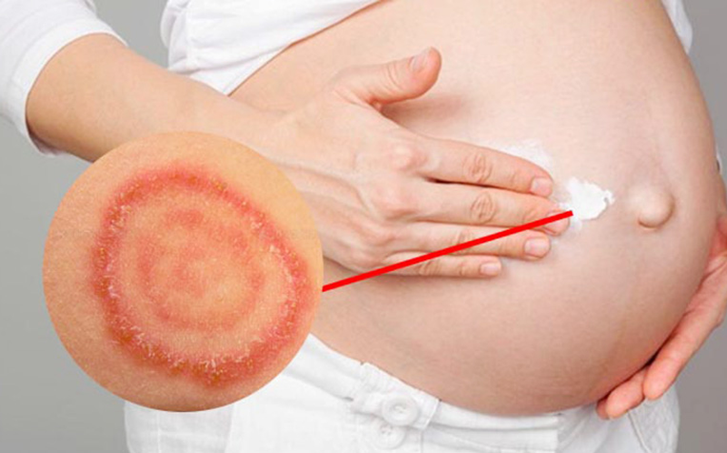 Bị hắc lào khi mang thai có gây nguy hiểm không? Cách phòng ngừa thế nào? 1