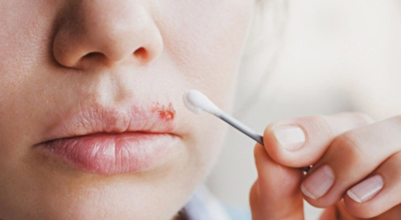 Bị herpes môi kiêng ăn gì và nên ăn gì để không bị viêm loét nhiều hơn? 3