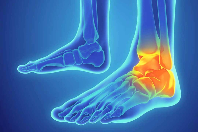 Chấn thương cổ chân không nên và nên ăn gì để vết thương nhanh hồi phục -  Nhà thuốc FPT Long Châu