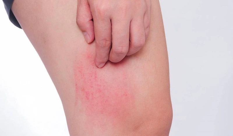 Bị ngứa khắp người không rõ nguyên nh-n có thể là triệu chứng đầu tiên của các loại dị ứng