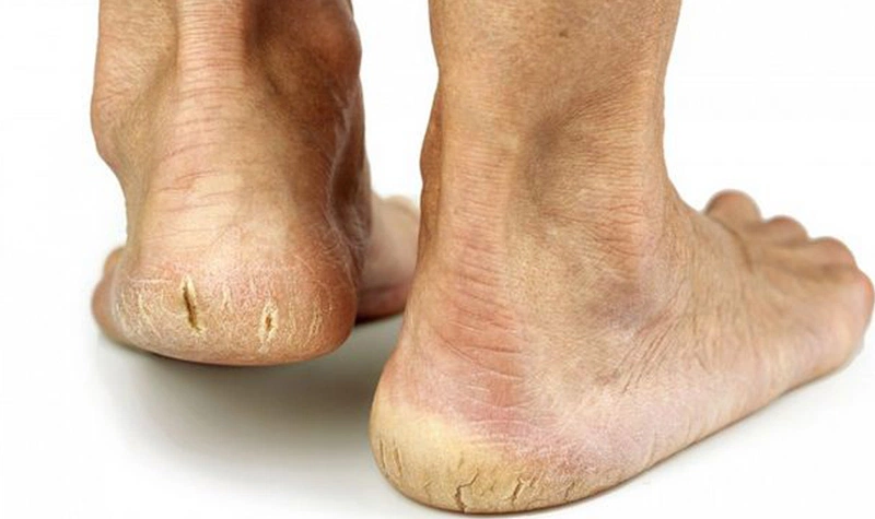 Bị nứt gót chân là thiếu chất gì? 3 loại vitamin cần bổ sung gấp 1