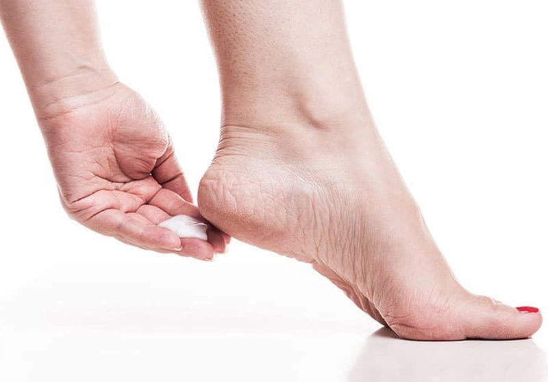 Bị nứt gót chân là thiếu chất gì? 3 loại vitamin cần bổ sung gấp 3
