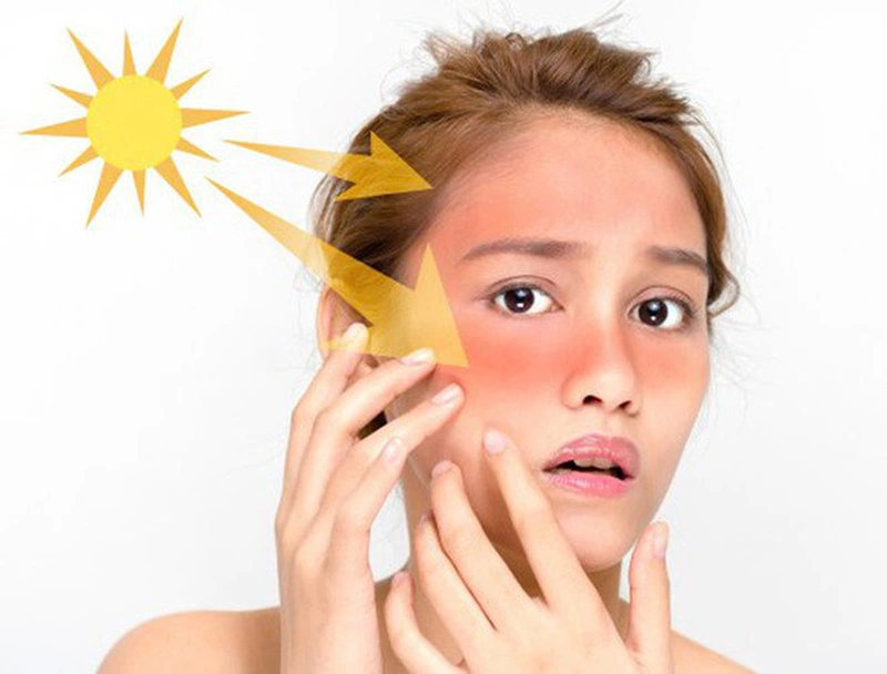 Tránh tiếp xúc với tia UV từ mặt trời để không gây kích ứng da