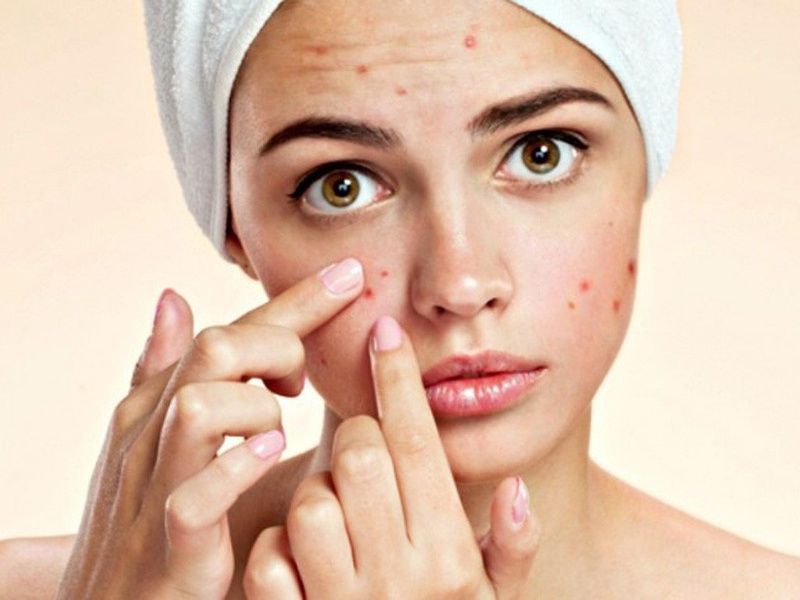 Bí quyết chọn nước hoa hồng dành cho da mụn mà các nàng cần biết