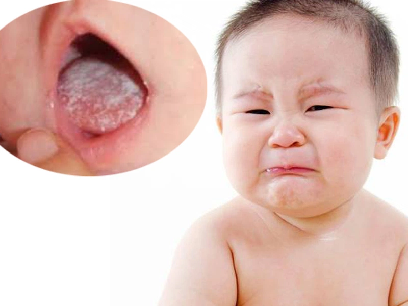 Bí quyết chữa nhanh bệnh nấm miệng ở trẻ