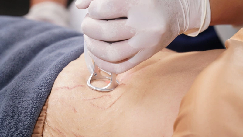 Bí quyết trị rạn da lâu năm không phải ai cũng biết 4