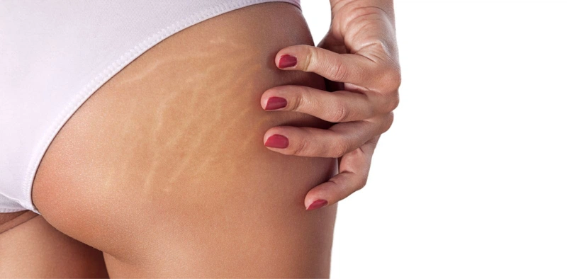 bị rạn da mông màu trắng 2