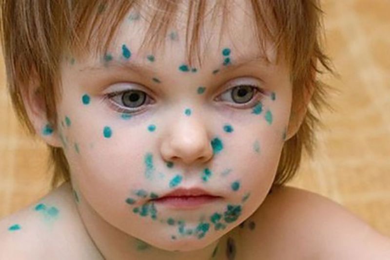 Bị thủy đậu mụn mủ có nguy hiểm không và cách xử lý 2