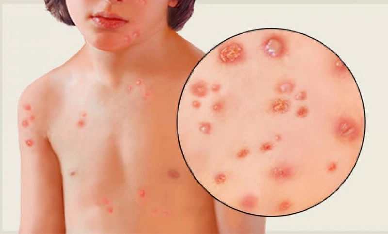 Bị thủy đậu mụn mủ có nguy hiểm không và cách xử lý 3