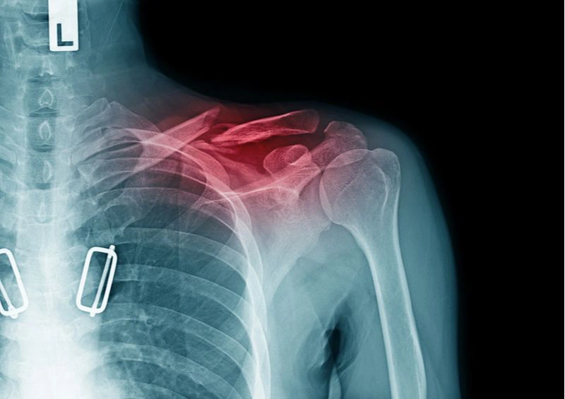 Bị trật khớp vai khi ngủ giải quyết như nào? 4