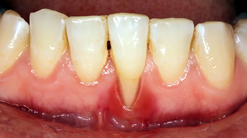 Mắc bệnh viêm chân răng uống thuốc gì để điều trị bệnh? 2