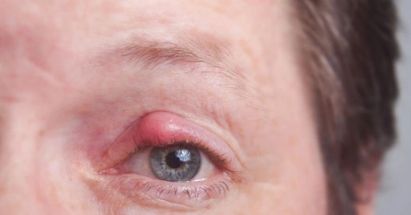 Khi virus herpes simplex tấn công vào bất kỳ bộ phận nào trên cơ thể, thì ở khu vực đó các mụn nước cũng sẽ xuất hiện