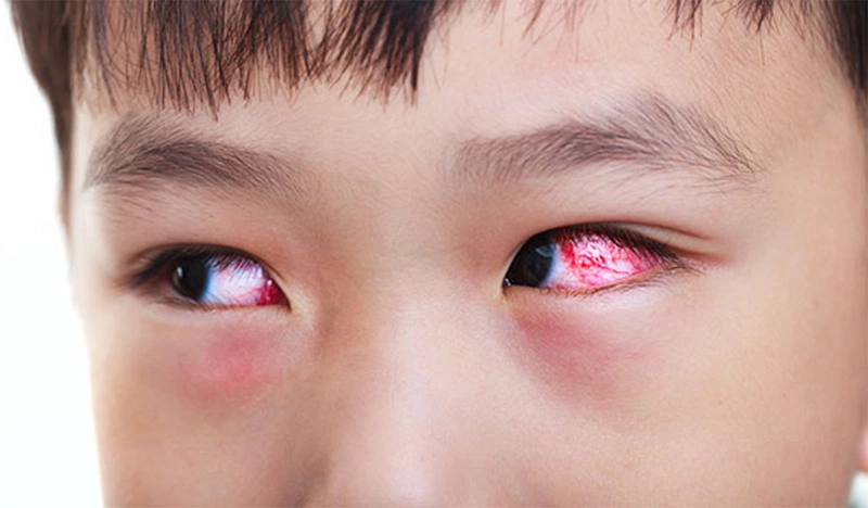Khi tiếp xúc với dị nguyên, người bệnh có nguy cơ bị viêm kết mạc dị ứng hay còn gọi là viêm giác mạc mùa xuân