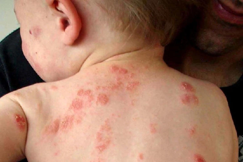 Bị zona bôi thuốc gì - Những loại thuốc cần ghi nhớ