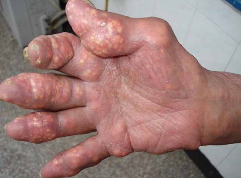 Biến chứng của Gout nguy hiểm như thế nào?