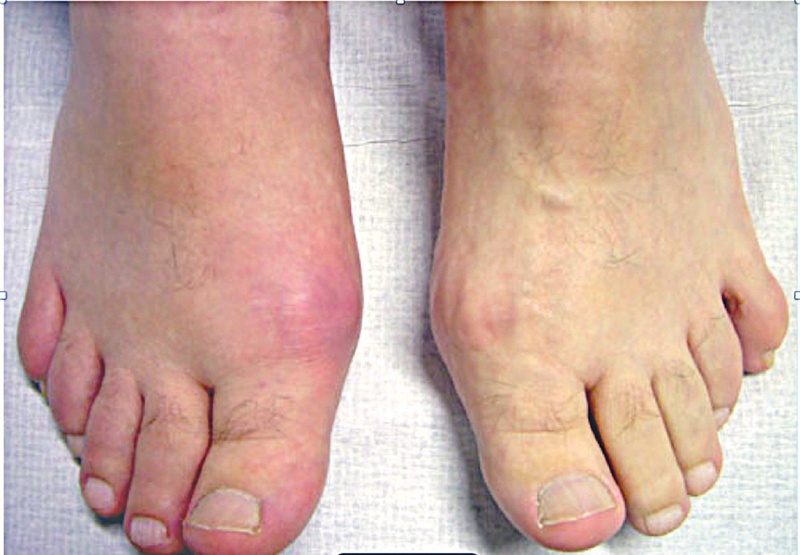 Biến chứng của Gout nguy hiểm như thế nào?