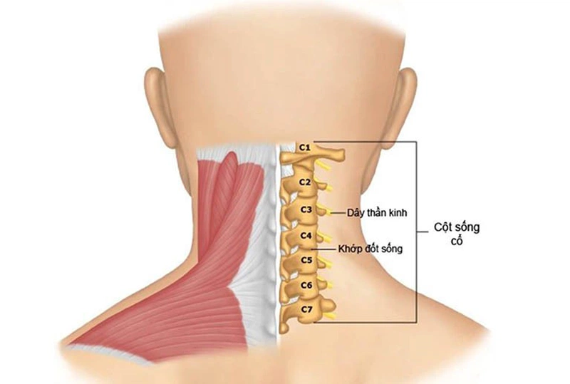 Biến chứng khó lường của thoái hóa cột sống chèn dây thần kinh và cách điều trị 1