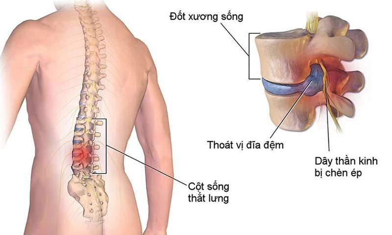 Biến chứng khó lường của thoái hóa cột sống chèn dây thần kinh và cách điều trị 2