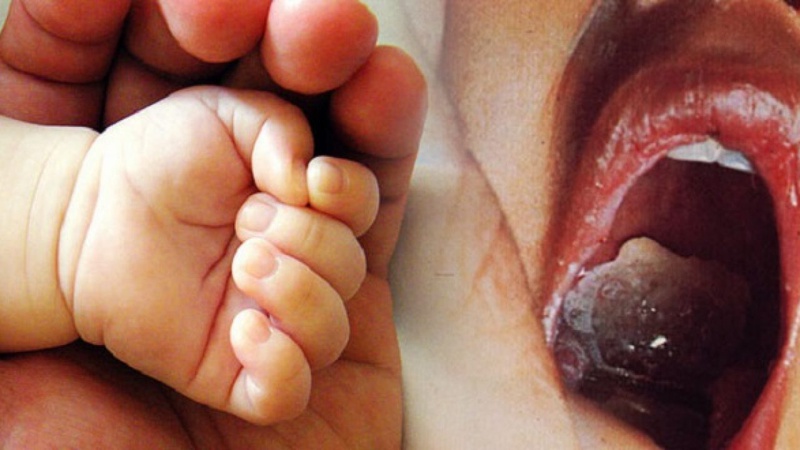 Bệnh bạch hầu gây ra nhiễm khuẩn cấp tính ở amidan
