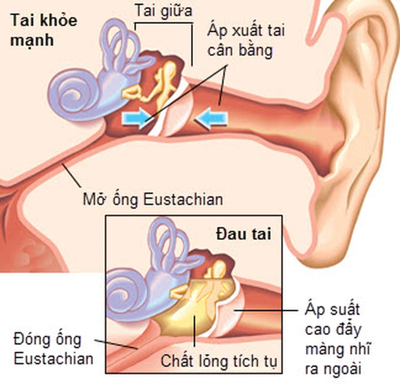 Có biến chứng sau mổ viêm tai giữa không? Điều trị như thế nào? 2