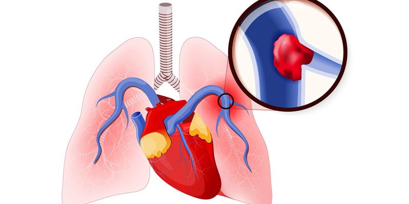 Nguyên nhân gây ra thuyên tắc phổi là do sự di chuyển của cục máu đông