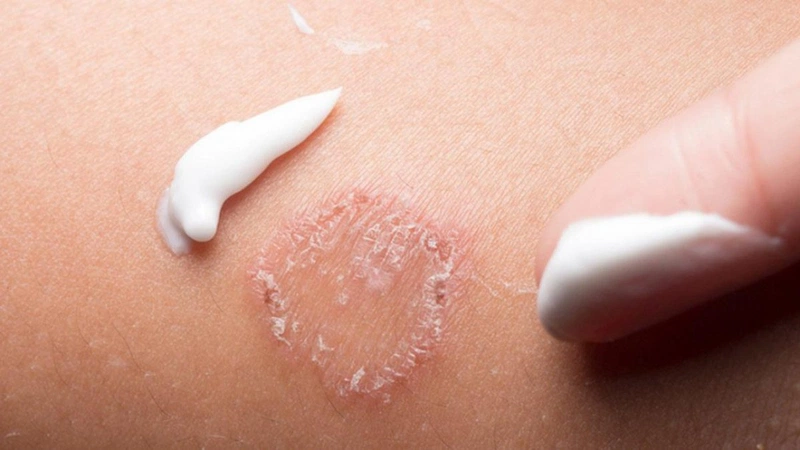 Biện pháp điều trị và chăm sóc khi hắc lào giai đoạn cuối 2